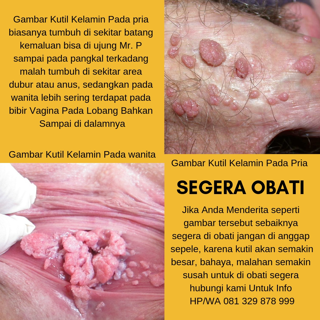 Salap Genital Warts Ubat Untuk Ketuat Alat Kelamin  Lelaki