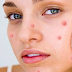 9 Effective Ways To Get Rid Of Pimples