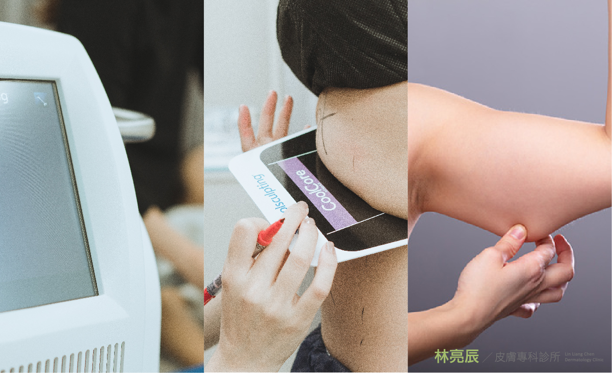 CoolSculpting酷塑冷凍減脂非侵入式效果好嗎? CoolSculpting酷塑冷凍減脂非侵入式效果好嗎?
