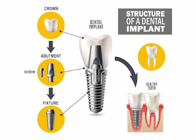 dental implant structure