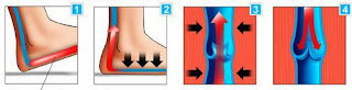 tratamiento varices piernas hinchadas edema venas