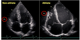 Сердце атлета. Гипертрофия левого желудочка сердца.