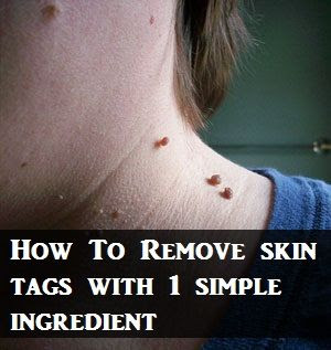 How To Remove Skin Tags With One Simple Ingredient