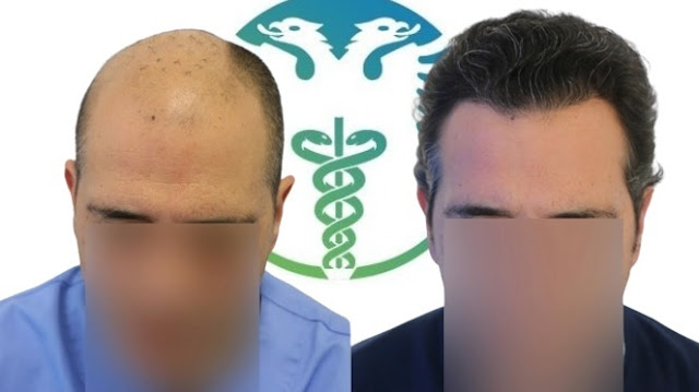 Paziente di 54 anni dopo trapianto di capelli presso Turismo Medico Albania, 4300 innesti, prima e dopo 12 mesi.