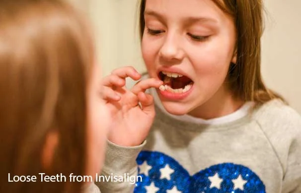 Why Loose Teeth From Invisalign?