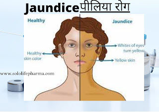 Jaundice Jaundice || jaundice symptoms || jaundice causes || types of jaundice || jaundice in adults || Jaundice treatment