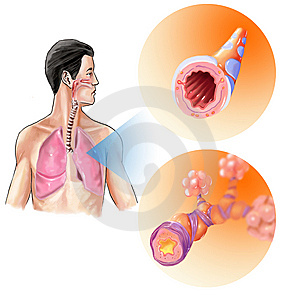 9 Nursing Diagnosis for Bronchitis