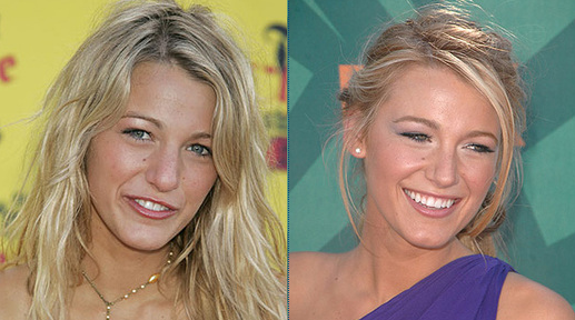 before and after nose jobs celebrity. efore and after nose job