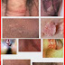 Obat Instan Alami Obati Kutil Kelamin thumbnail