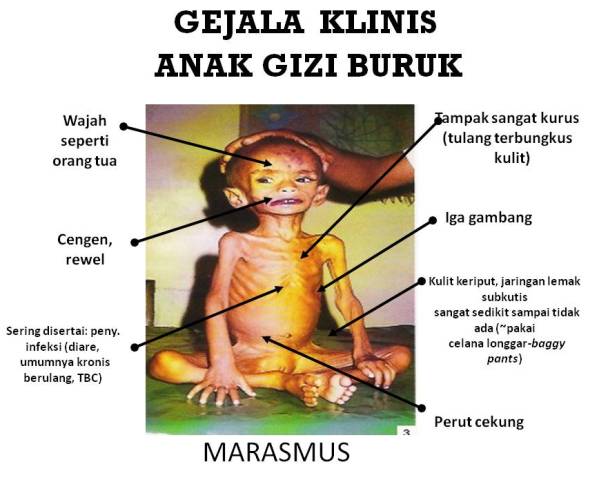 Puskesmas Kembang Janggut: Symptom atau Gejala Klinis Gizi Buruk 