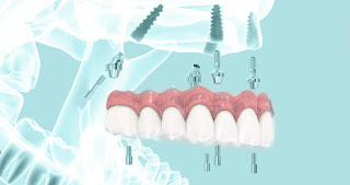 Cấy implant có nguy hiểm không-1