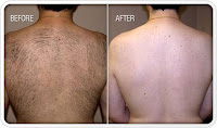 hair removal photo before and after