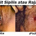 Obat Sipilis Untuk Wanita