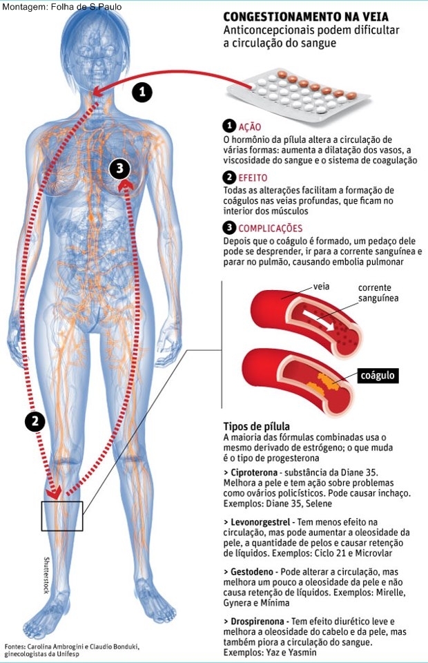 anticoncepcional efeito colateral embolia pulmonar