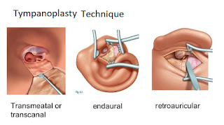 Procedure of Tympanoplasty 