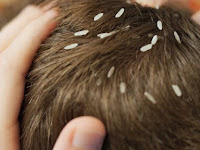 Cara Menghilangkan Kutu Di Rambut Secara Alami