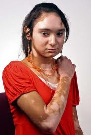 pengobatan vitiligo  Pantangan  yang Harus Dihindari 