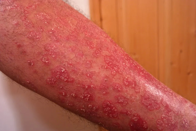 fungal infection and skin diseases