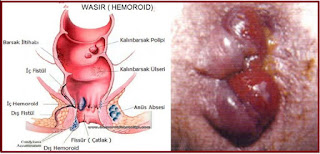 Obat Wasir Yang Aman Untuk Ibu Hamil Atau Menyusui