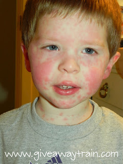 Allergic Reaction To Children in Germany