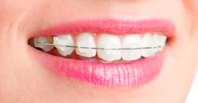 Niềng răng có nguy hiểm không cần dựa vào nhiều yếu tố?