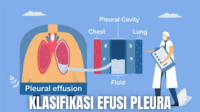 Klasifikasi Efusi Pleura Pada Manusia Efusi Pleura Transudat Pada efusi jenis transudat ini keseimbangan kekuatan menyebabkan pengeluaran cairan dari pembuluh darah. Mekanisme terbentuknya transudat karena peningkatan tekanan hidrostatik (CHF), penurunan onkotik (hipoalbumin) dan tekanan negatif intra pleura yang meningkat (atelektasis akut).  Ciri-ciri cairan :  Serosa jernih Berat jenis rendah (dibawah 1,012) Terdapat limfosit dan mesofel tetapi tidak ada neutrofil Protein < 3 %  Penimbunan cairan transudat dalam rongga pleura dikenal dengan hydrothorax, penyebabnya :  Payah jantung Penyakit ginjal (SN) Penyakit hati (SH) Hipoalbuminemia (malnutrisi, malabsorbsi)    Efusi Pleura Eksudat Eksudat ini terbentuk sebagai akibat penyakit dari pleura itu sendiri yang berkaitan dengan peningkatan permeabilitas kapiler (misal pneumonia) atau drainase limfatik yang berkurang (misal obstruksi aliran limfa karena karsinoma).  Ciri cairan eksudat :  Berat jenis > 1,015 % Kadar protein > 3 % atau > 30 g/dl Ratio protein pleura berbanding LDH serum . 0,6 LDH cairan pleura lebih besar dari pada 2/3 batas atas LDH serum normal Warna cairan keruh  Penyebab dari efusi eksudat ini adalah  kanker : karsinoma bronkogenik, mesotelioma atau penyakit metastatik ke paru atau permukaan pleura Infark paru Pneumonia Pleuritis virus    Nah itu dia bahasan dari Klasifikasi Efusi Pleura pada manusia, melalui bahasan di atas bisa diketahui mengenai Klasifikasi Efusi Pleura pada manusia. Mungkin hanya itu yang bisa disampaikan di dalam artikel ini, mohon maaf bila terjadi kesalahan di dalam penulisan, dan terimakasih telah membaca artikel ini."God Bless and Protect Us"