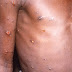 African Scientists Baffled by Monkeypox Cases in Europe, US