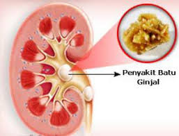 Efek samping setelah operasi batu ginjal