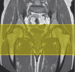 hip mri