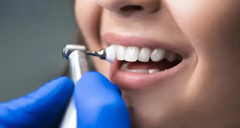 What-Is-Dental-Scaling