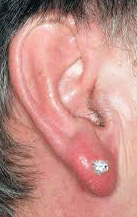 earring infection