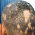 Queda de cabelo masculino - O que é alopecia areata - Alopecia tem cura. 