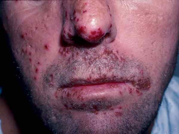 herpes mouth sores. Cold sores and fever blisters