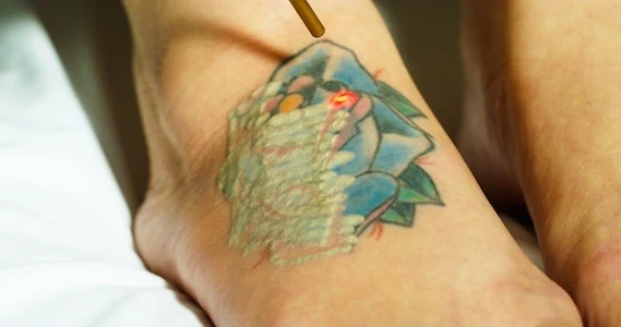 Eliminando un tatuaje multicolor