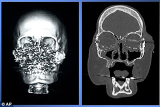 connie culp x rays after being shot in the face by her husband