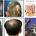 Grow Long Hair, 100% Natural Hair Loss Treatment, Cure Baldness, Remove Dandruff Thin Hair Hair Fall