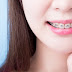 What You Should Know About Braces Singapore