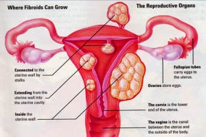 Penyakit Mioma Uteri