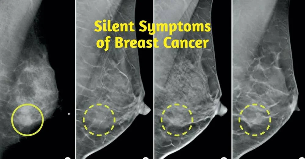 10 Silent Symptoms of Breast Cancer You Should Never Ignore