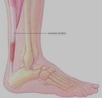 Asuhan Keperawatan Pada Pasien Achilles Tendinitis