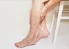 Varicose veins treatment exists at home but little they know it!