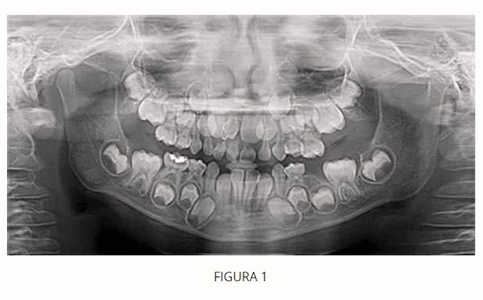 DIENTES SUPERNUMERARIOS: Problemas asociados con su presencia - Caso Clínico