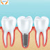 Dental Implant or Dental Bridges: What to Choose?