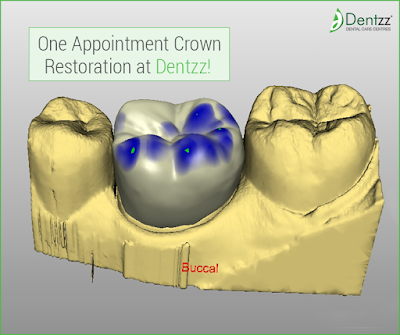 Cerec Restoration at Dentzz