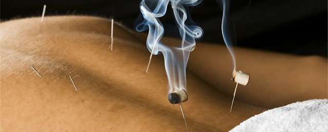 Acupuncture/moxibustion