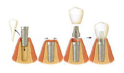 Chi phí để thực hiện cấy ghép răng implant.