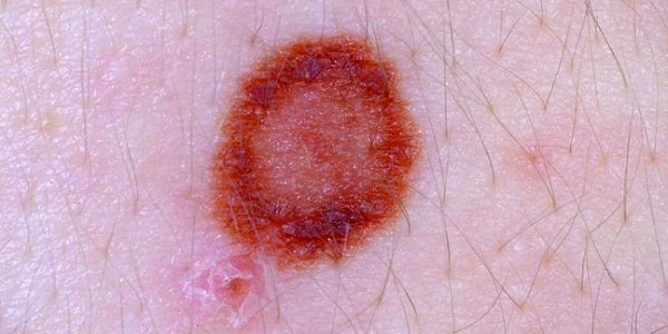 Must watch Skin Cancer Photos to identify it