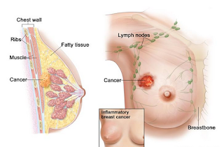 Mengobati Kanker Payudara Secara Tradisional, Artikel Obat Alami Mujarab Kanker Payudara, Cara Alami Mengatasi Penyakit Kanker Payudara