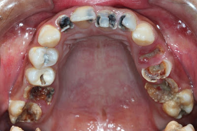 Cách khắc phục răng sâu bị đen