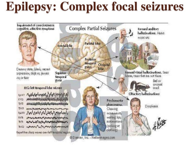 complex focal seizure